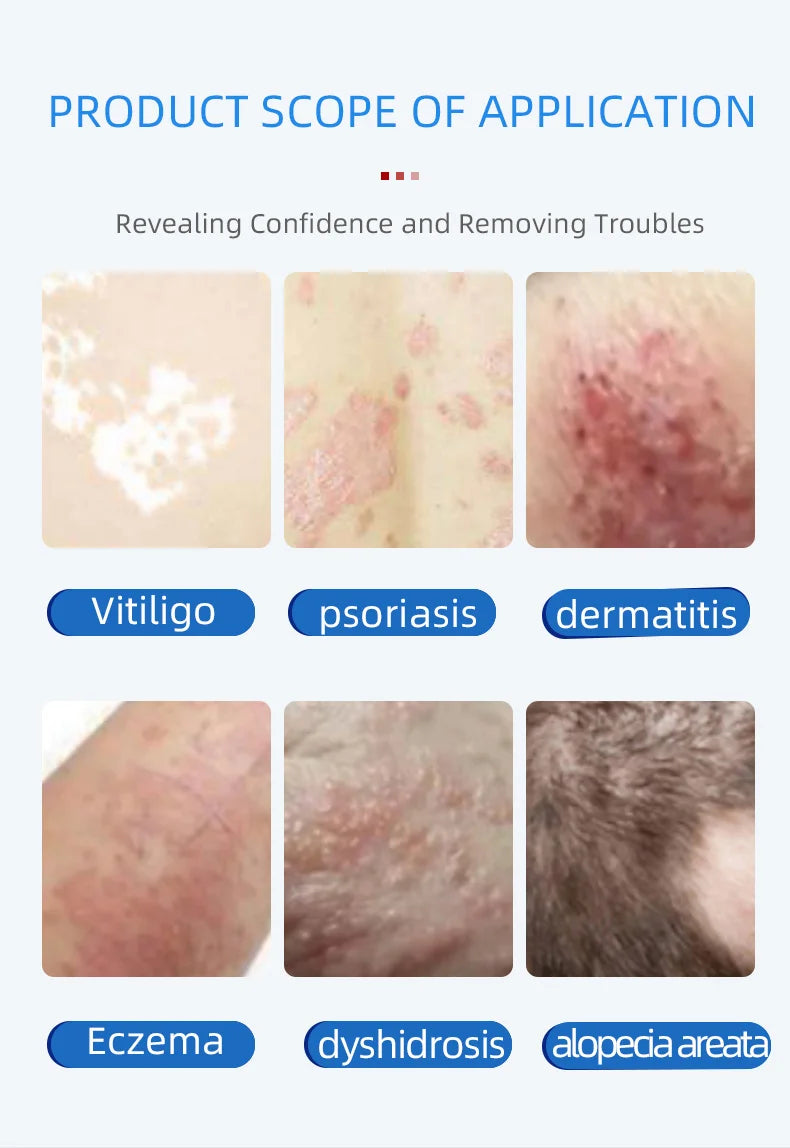 Uvb Lamp Vitiligo Physical Therapy Equipment Narrowband Light Lamp Medical Light Source UV 311nm Therapy For Psoriasis Eczema