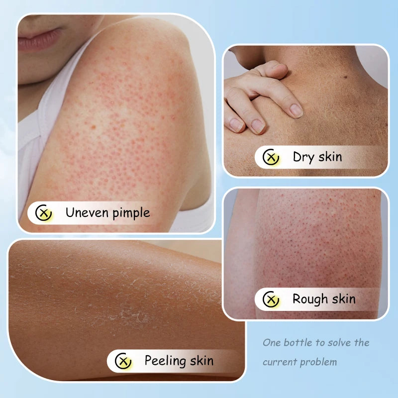 100g Chicken Skin Removal Cream Body Repair Keratosis Pilaris Rough Bumpy Pore Spots Dull Skin Care Whitening Moisturizing