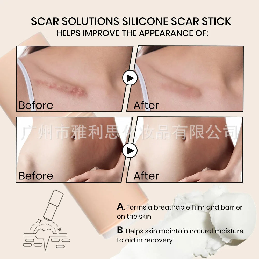 KOEC Silicone Scar Stick Smoothing Moisturizing Soothing Remodel Texture Restore Skin Integrity CICA Vitamin E Plant Extracts