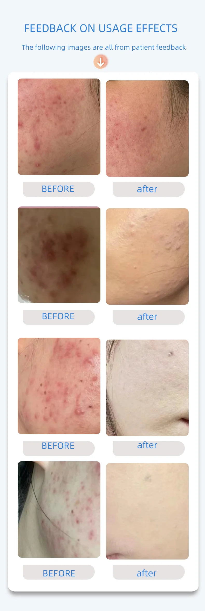 Uvb Lamp Vitiligo Physical Therapy Equipment Narrowband Light Lamp Medical Light Source UV 311nm Therapy For Psoriasis Eczema